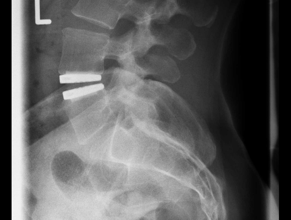 1 level ADR lumbar Lateral